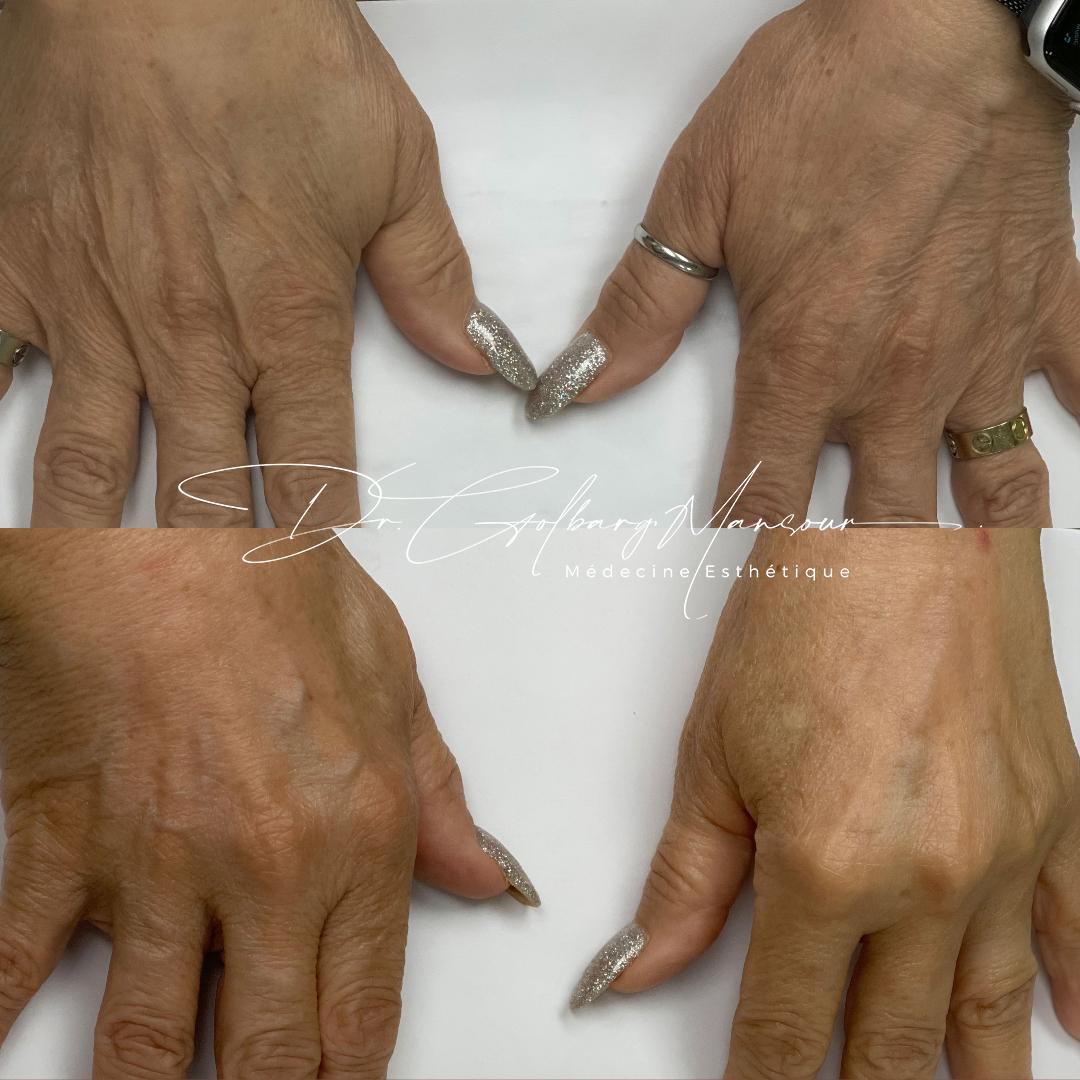 Hand rejuvenation Treatment in Montreal