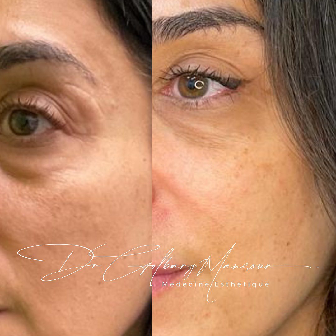 Undereye fillers before & after