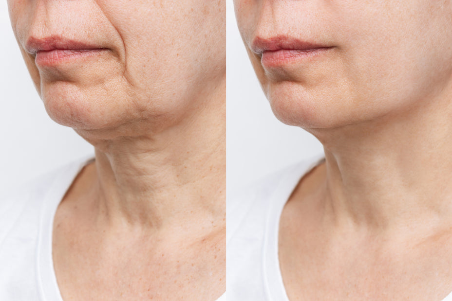 Non-surgical Neck Lift Montreal at Clinique Esthétique HoMa