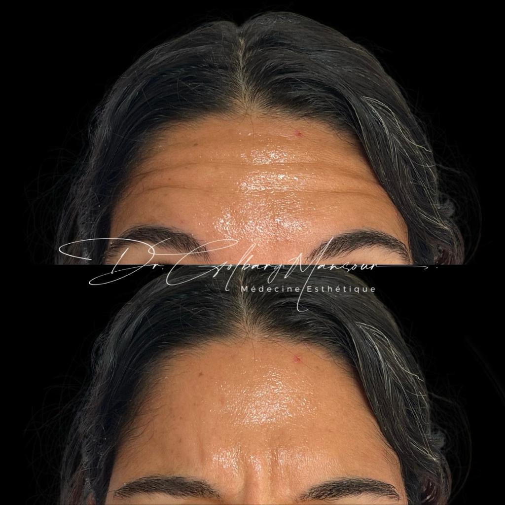 Before & After Forehead Botox Montreal - Clinique Médico Esthétique HoMa