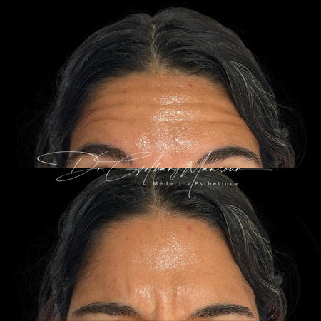 Before & After Forehead Botox Montreal - Clinique Médico Esthétique HoMa