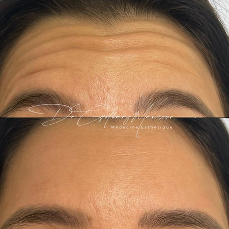 Before & After Forehead Botox Montreal - Clinique Médico Esthétique HoMa
