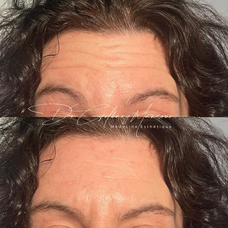 Before & After Forehead Botox Montreal - Clinique Médico Esthétique HoMa