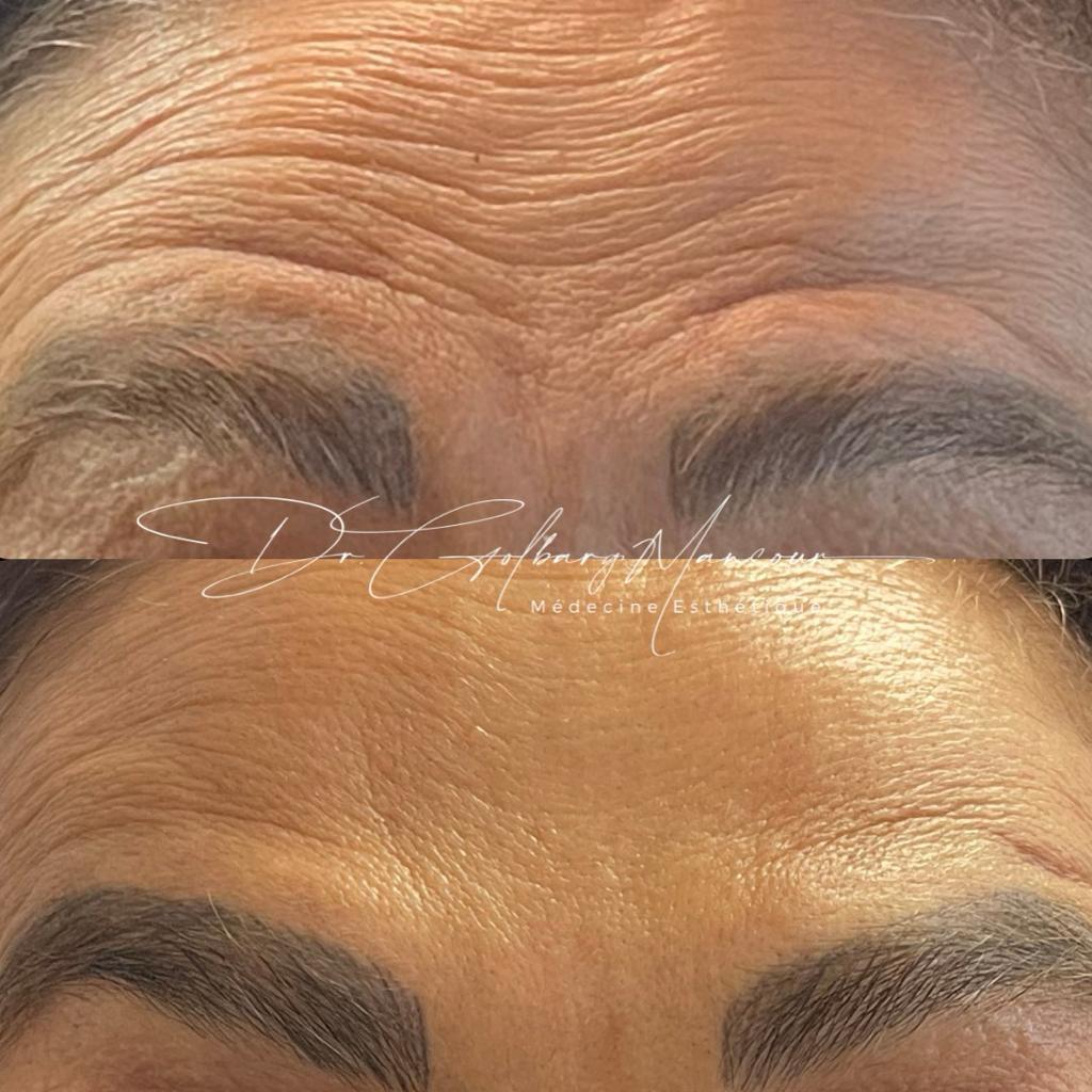 Before & After Forehead Botox Montreal - Clinique Médico Esthétique HoMa