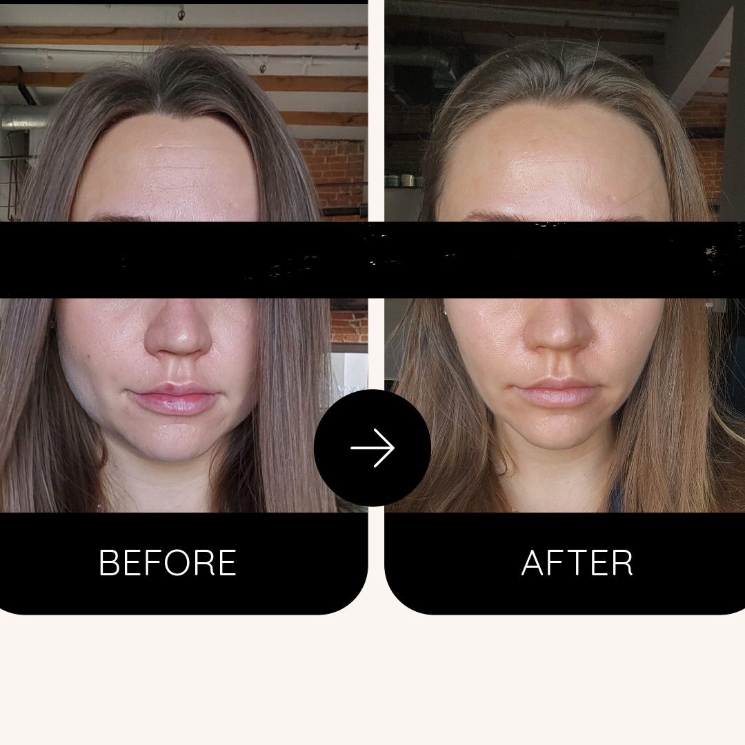 Best Masseter Botox Montreal