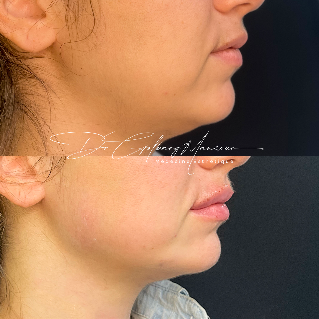 Before & after chin fillers montreal clinique esthétique HoMa