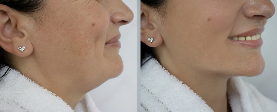 Double chin removal Montreal