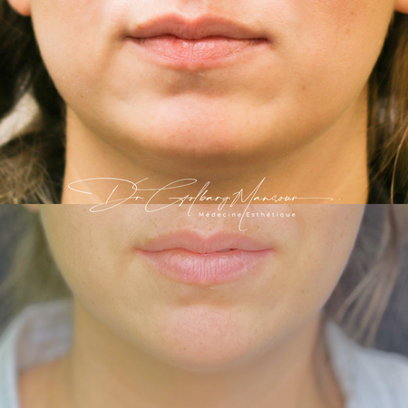 Before & after masseter botox montreal clinique esthétique HoMa