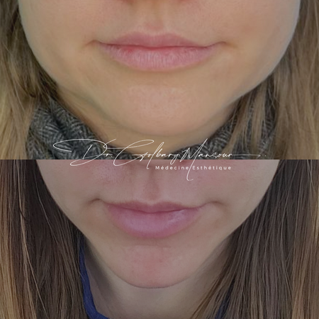 before & after masseter botox