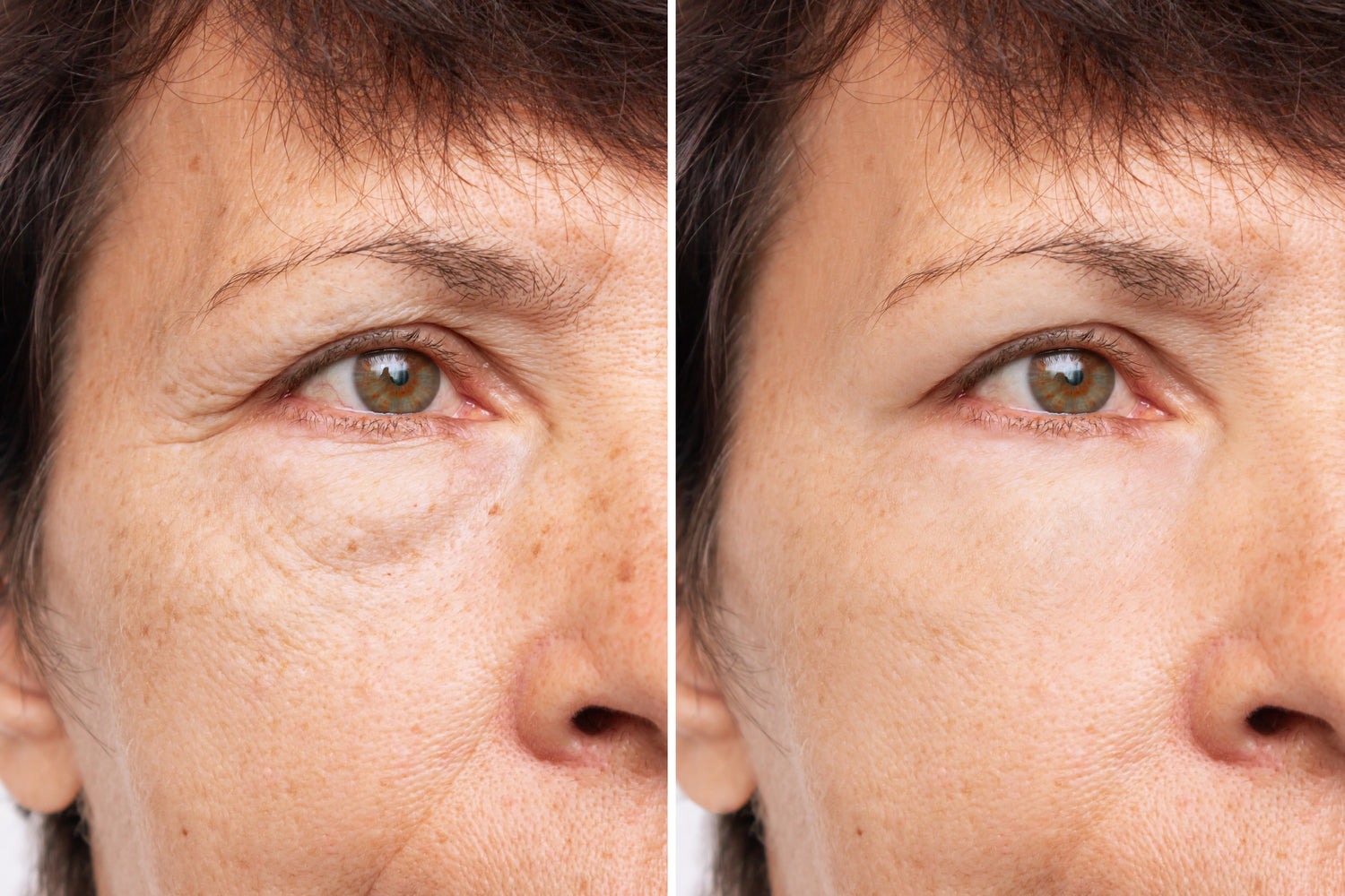 undereye fillers