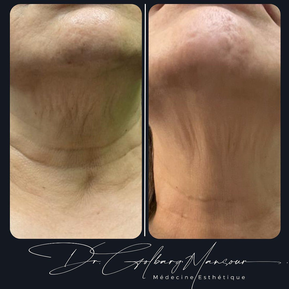 Nose Fillers before & after