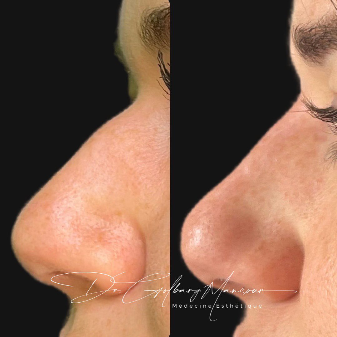 Before & After Nose Filler Montreal