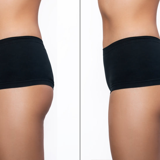 Non-Surgical Butt Lift Montreal