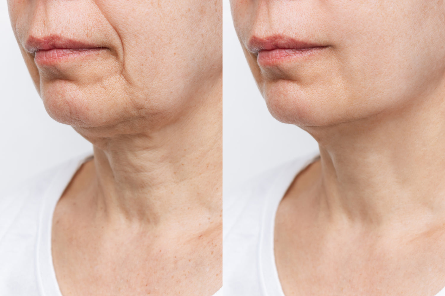 Non-surgical Neck Lift Montreal at Clinique Esthétique HoMa