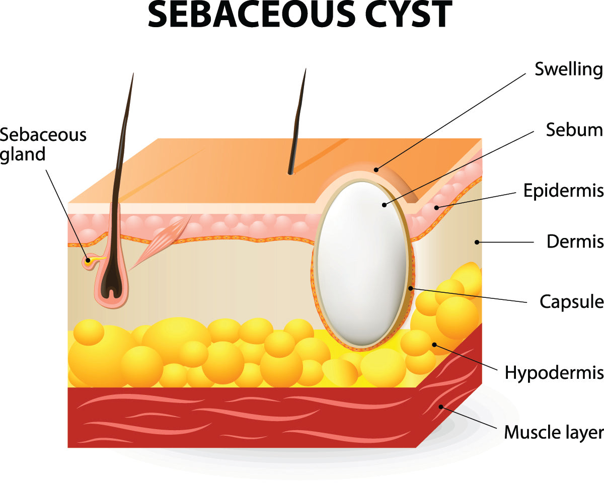 Sebaceous Cyst Removal Montreal