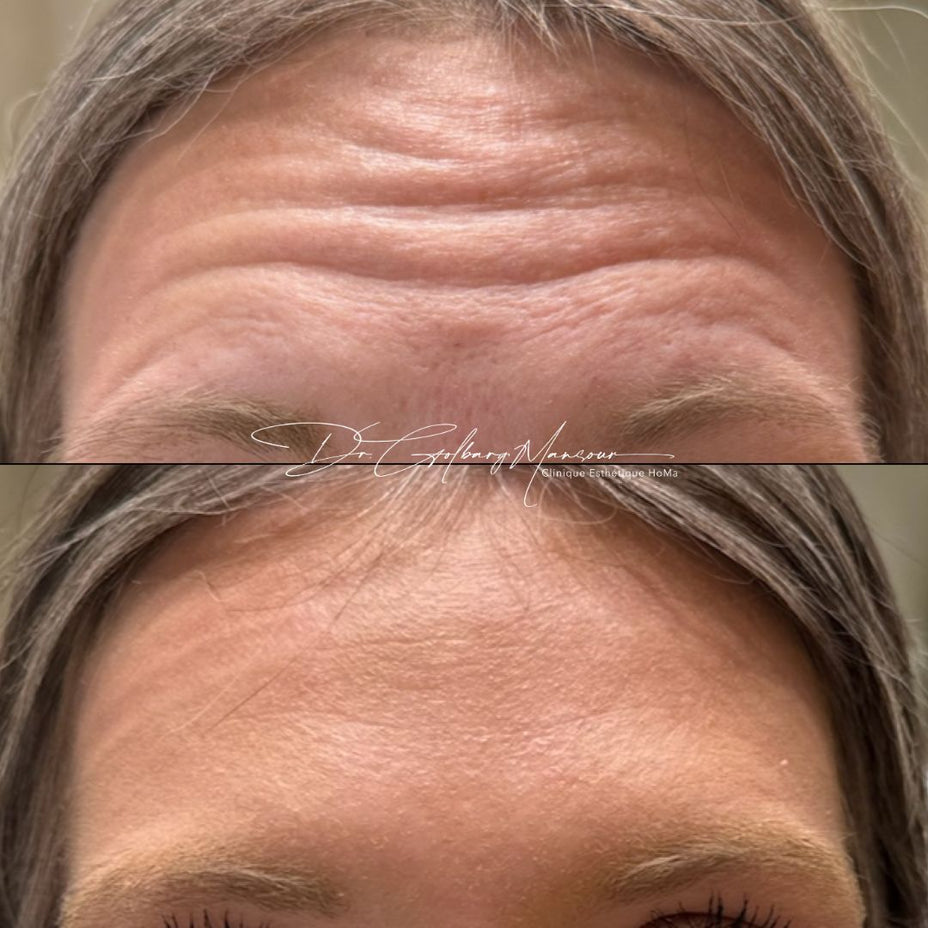 Forehead Wrinkles Injections