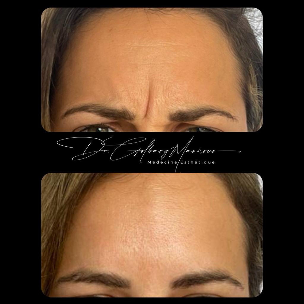 Best Glabella Botox Injections in Montreal – Clinique Esthétique HoMa