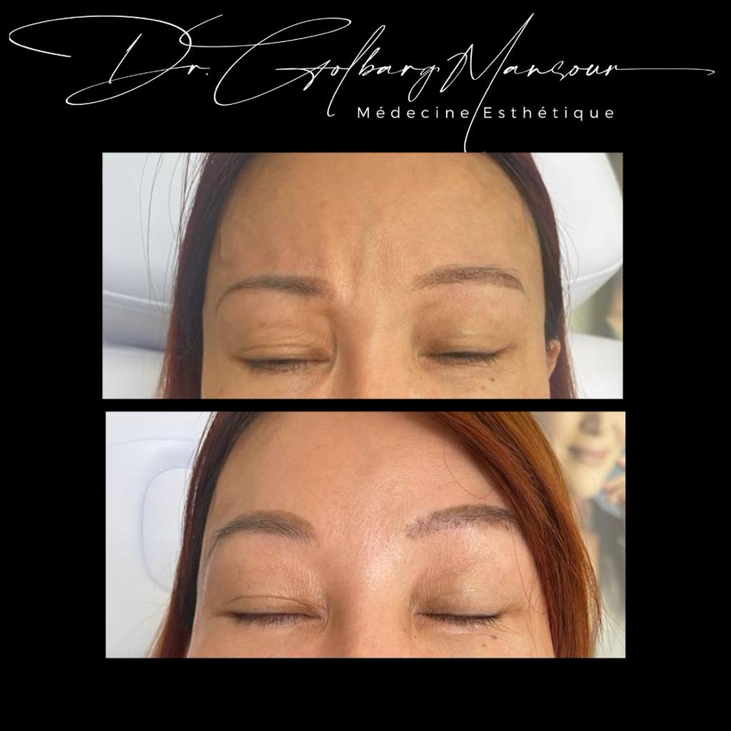 Botox Montreal / before & After Glabella Botox