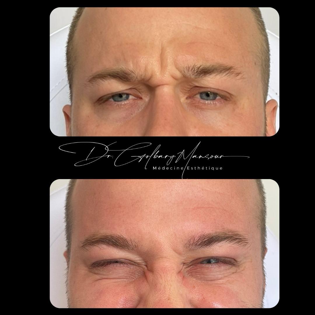 Best Glabella Botox Injections in Montreal – Clinique Esthétique HoMa