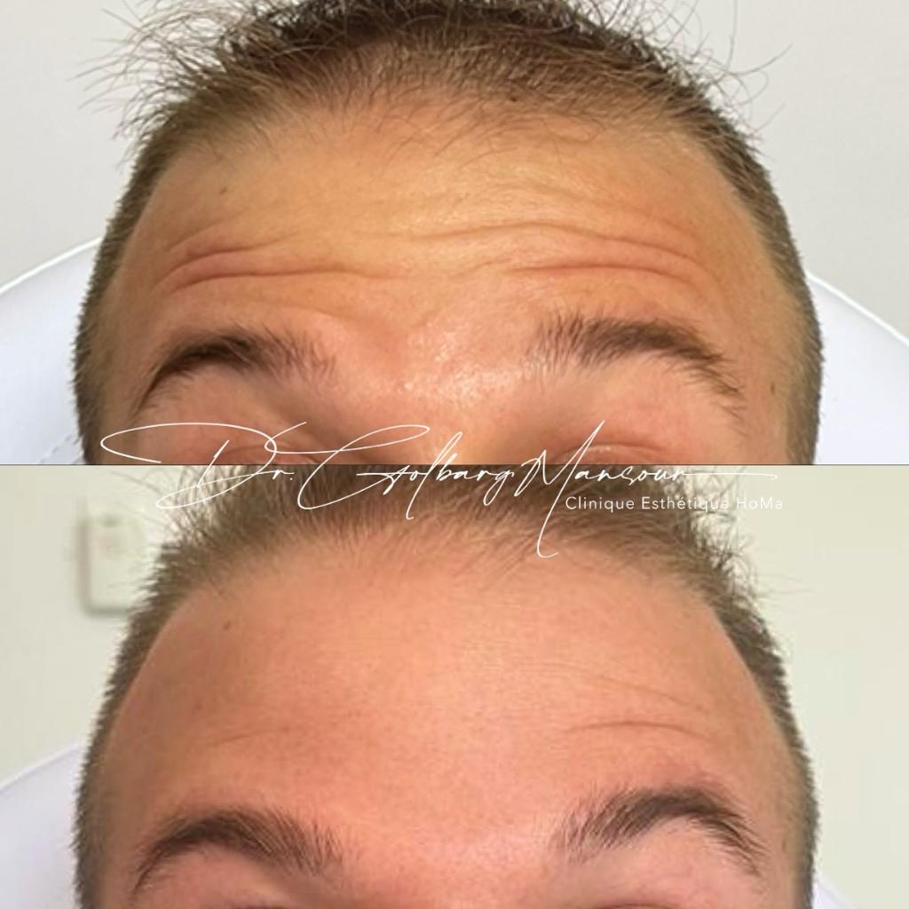 Forehead lines botox