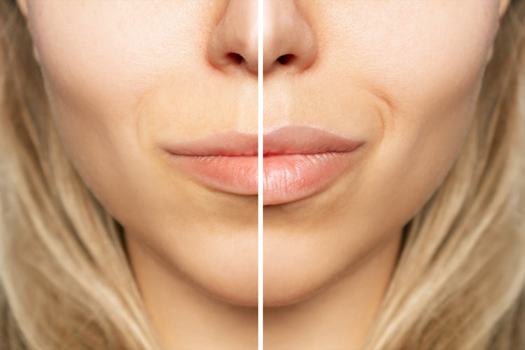 lip flip c'est quoi Tucson, AZ - Avant Dermatology BOTOX Lip Flip vs. Lip