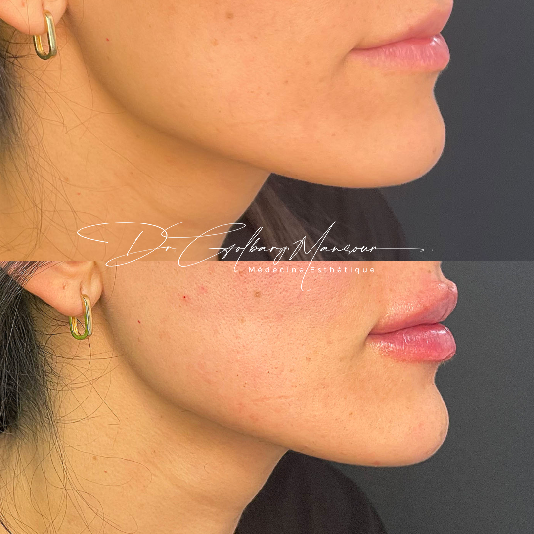 Before & after chin fillers montreal clinique esthétique HoMa