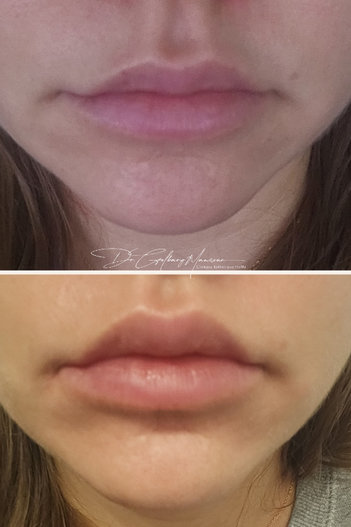 lip flip c'est quoi Lip Flip à Montréal, QC – Clinique Esthétique HoMa