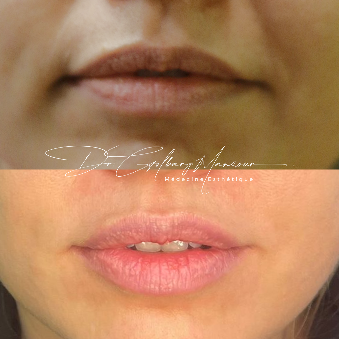 Before & after lip fillers montreal