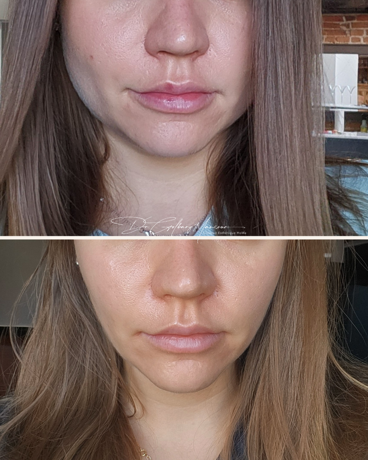 Masseter Injection Masseter Botox Injections Montreal – Clinique Esthétique HoMa