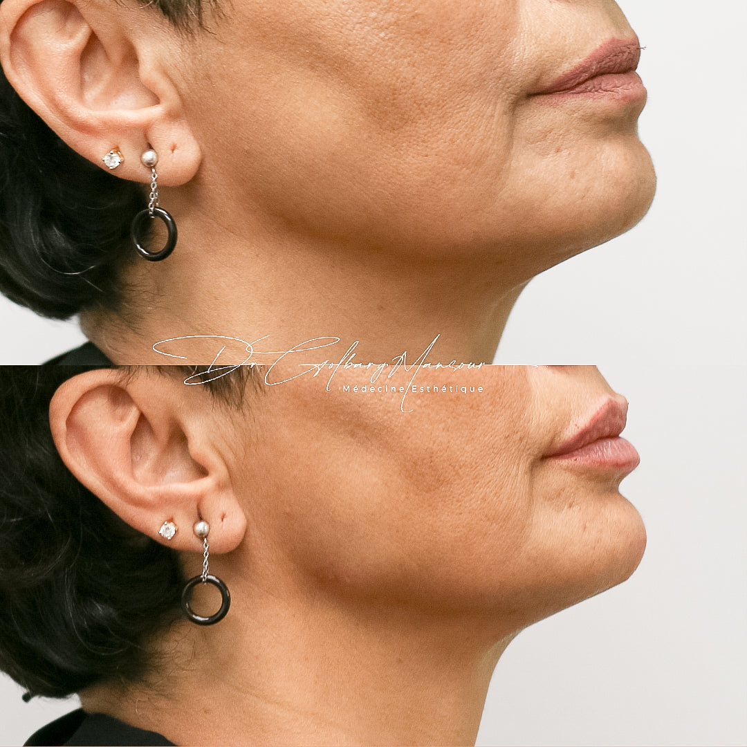 Before & after chin fillers montreal clinique esthétique HoMa