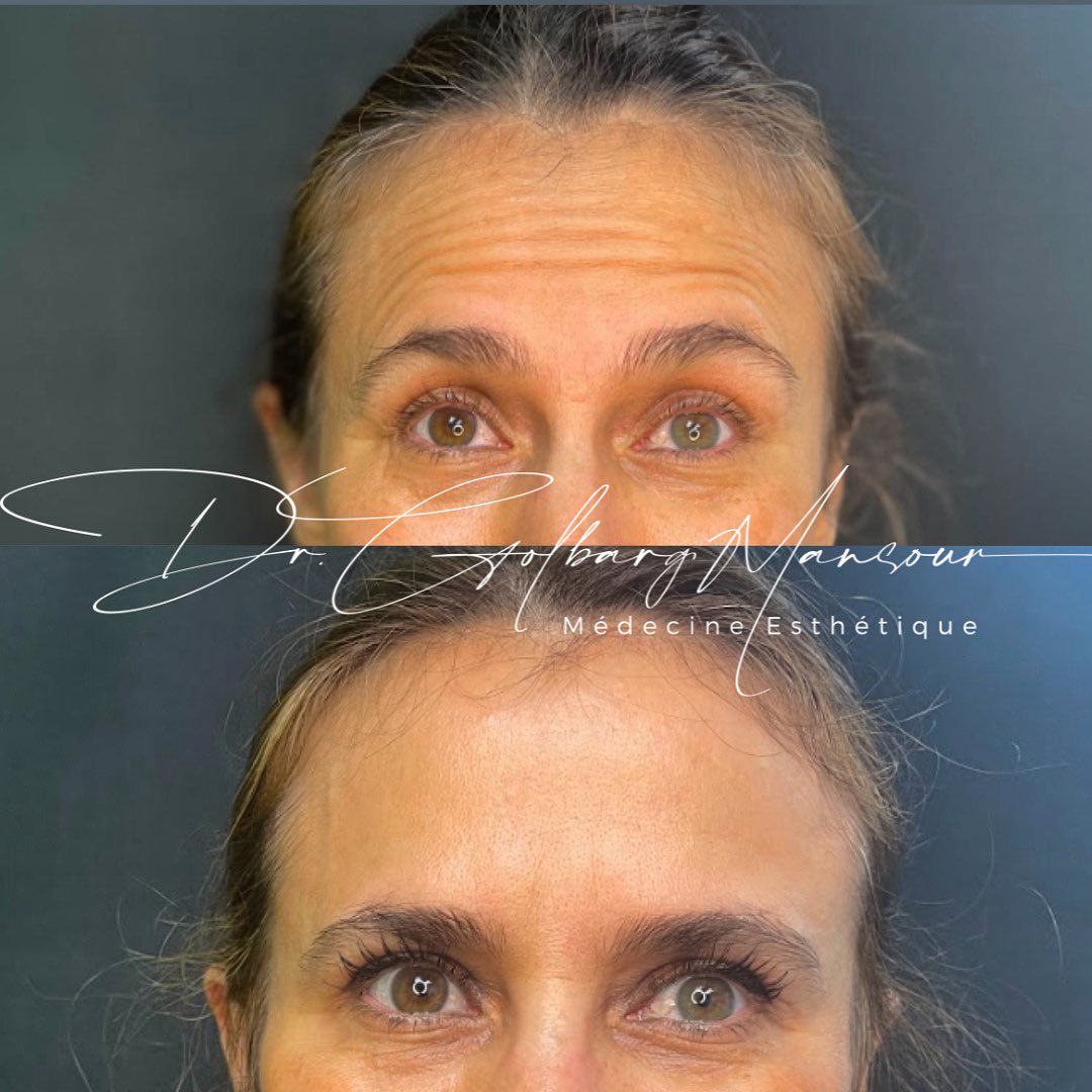 Before & After Forehead Botox - Clinique Médico Esthétique