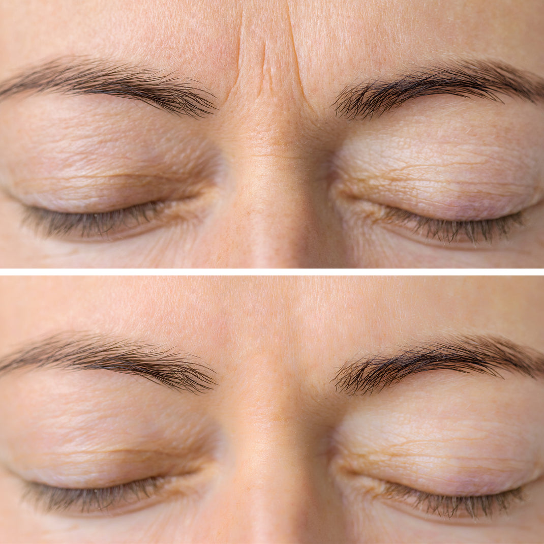 Best Glabella Botox Injections in Montreal Clinique Esthétique HoMa