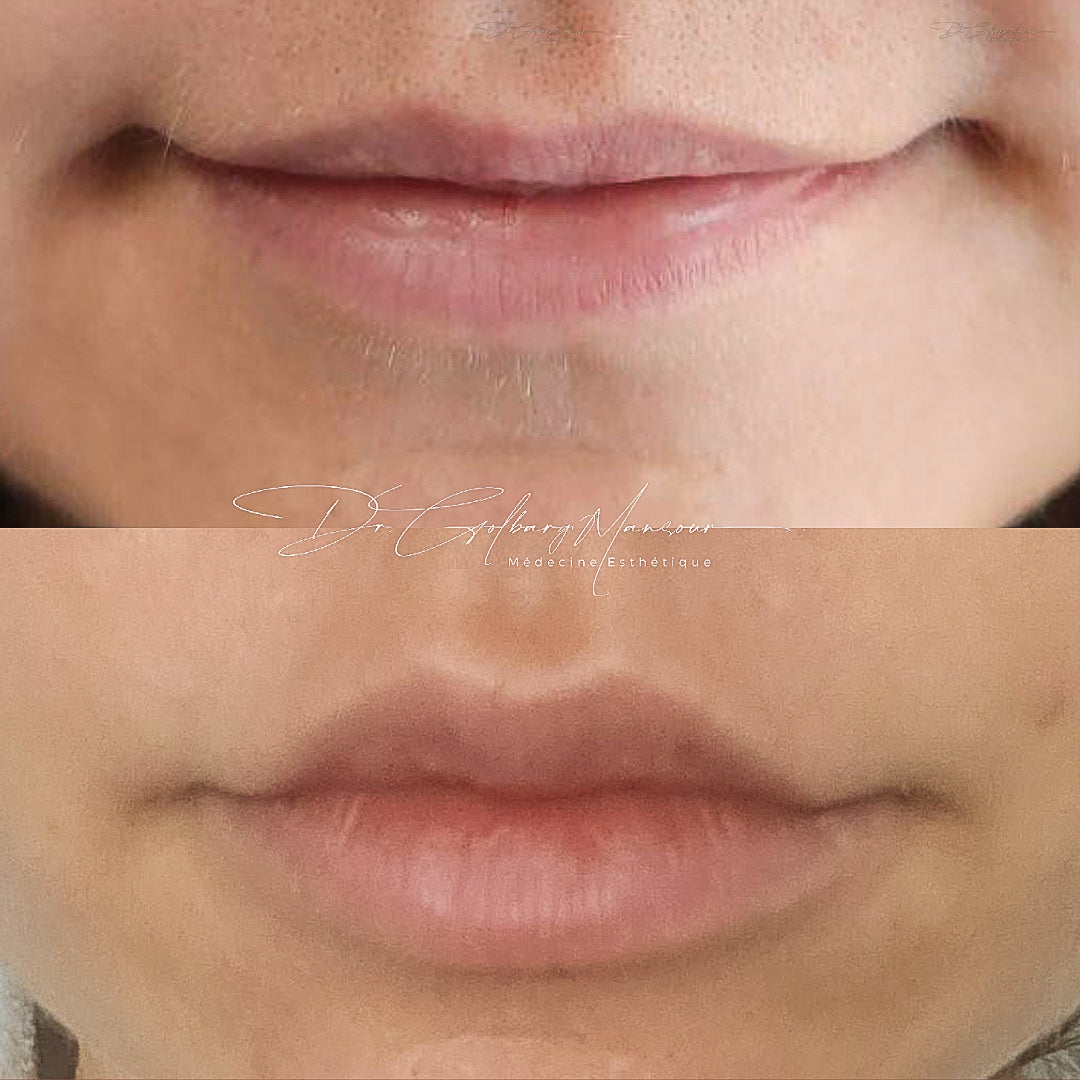 Before & after lip fillers montreal clinique esthétique HoMa