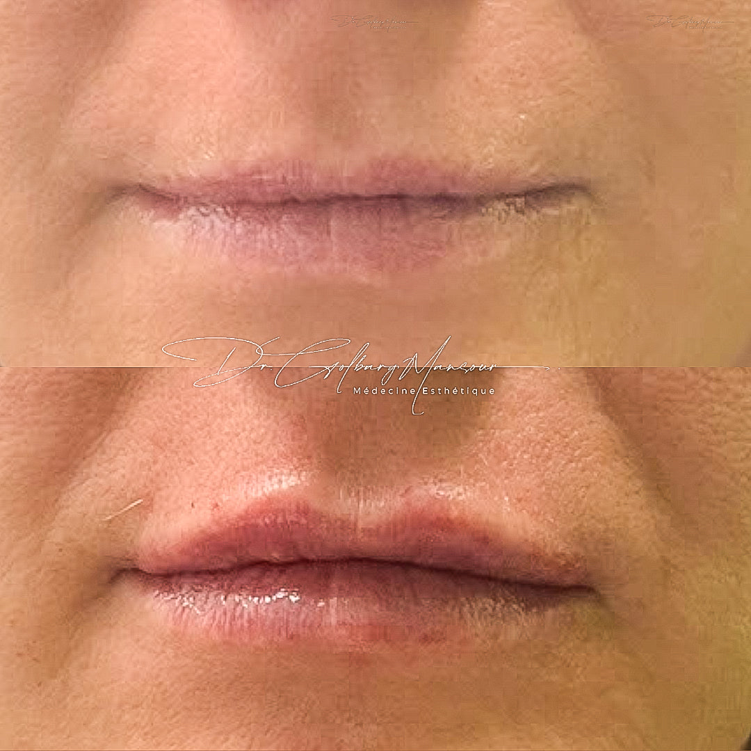 Before & after lip fillers montreal clinique esthétique HoMa