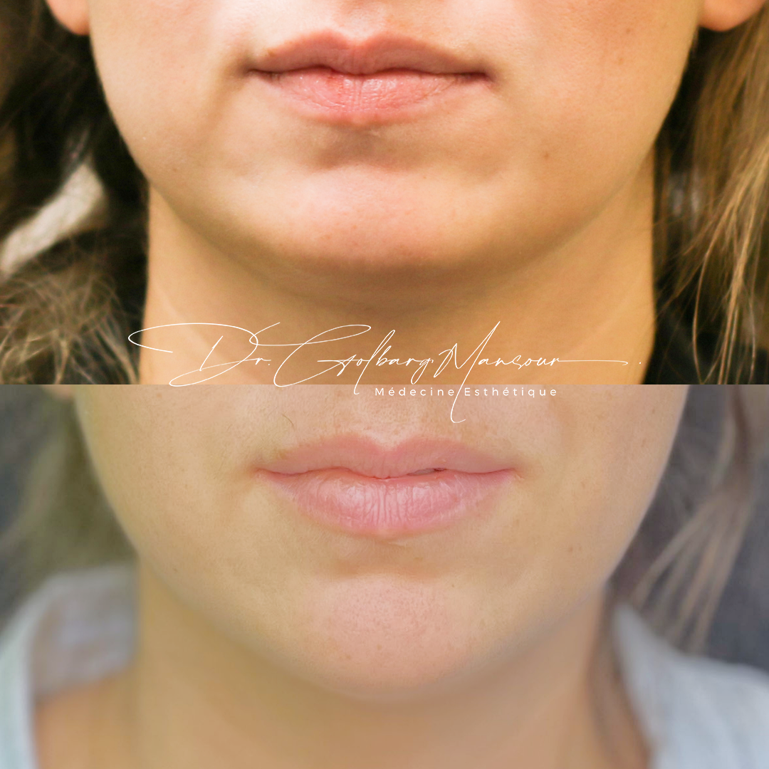 Before & after masseter botox montreal clinique esthétique HoMa
