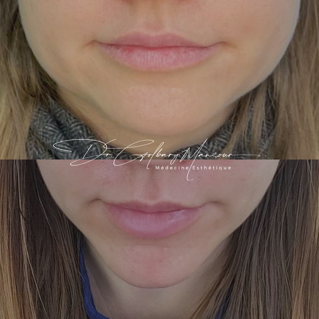 before & after masseter botox