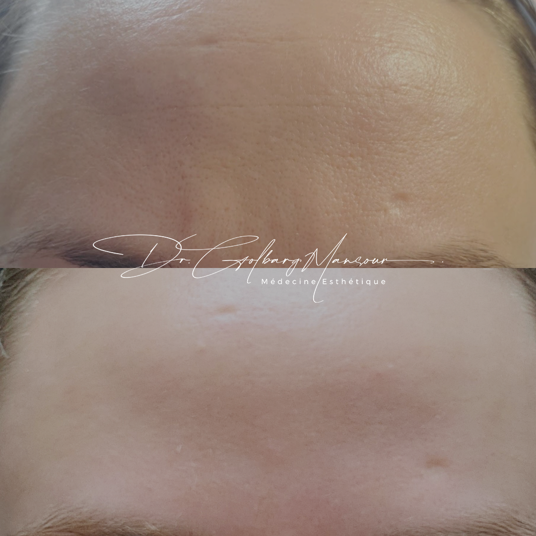 Microneedling results